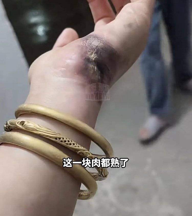 世界杯信用网平台出租_手被烧熟！金手镯被烧熔！女子给电动车充电世界杯信用网平台出租，不慎碰到充电口受伤