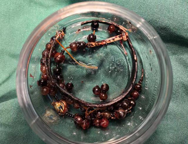 登1信用盘代理_女子手镯10年没摘竟“长”进肉里登1信用盘代理！医生：再晚点就保不住了